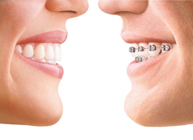 Invisalign Warszawa porównanie
