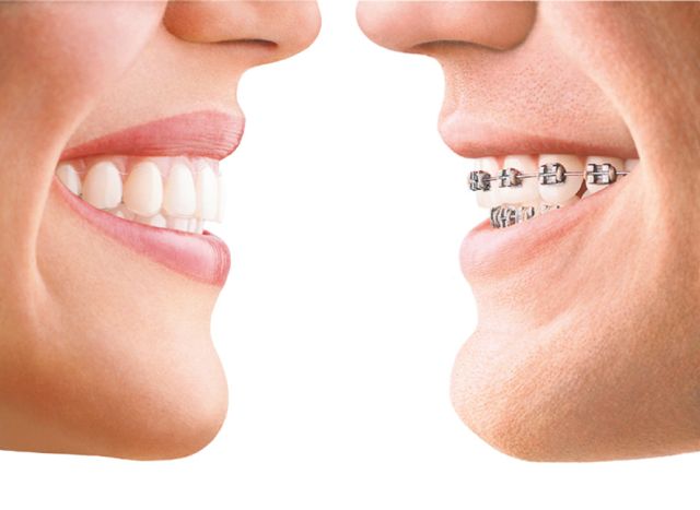 Invisalign Warszawa porównanie