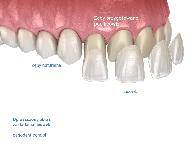 Licówki stomatologiczne zakładanie Periodent Warszawa